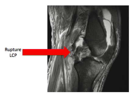 lesion meniscale