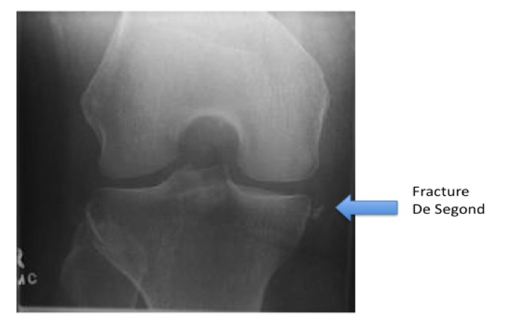 radiographie du genou