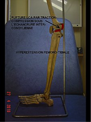 hyperextension