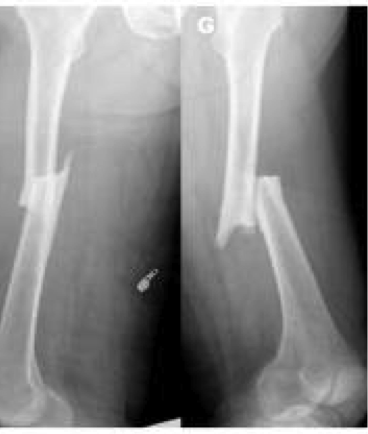 fracture du femur