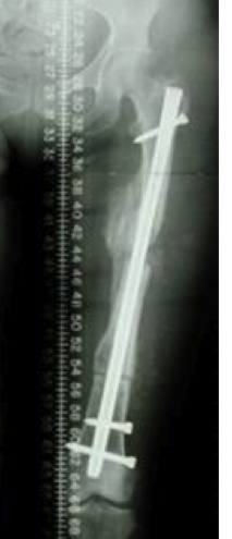 fracture du femur