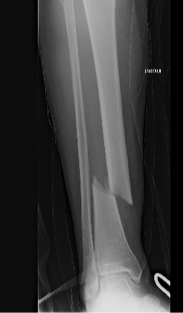 fracture de jambe