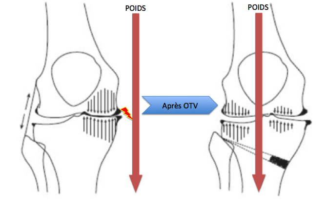 osteotomie