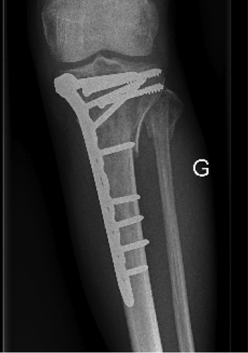 Dr Cyril Mayer - Fractures du plateau tibial